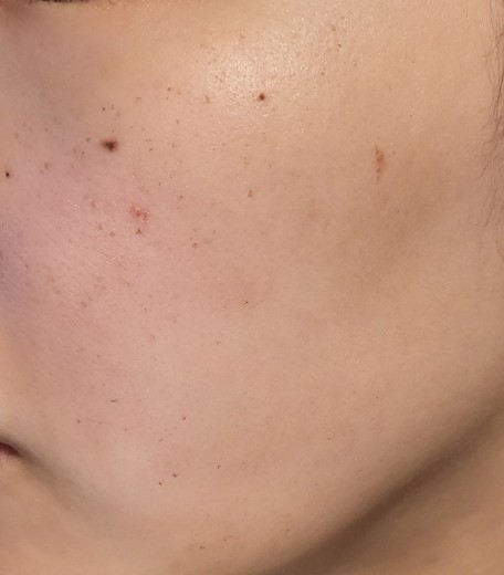 after photo: IPL(光/フォト治療), 診断・検査
