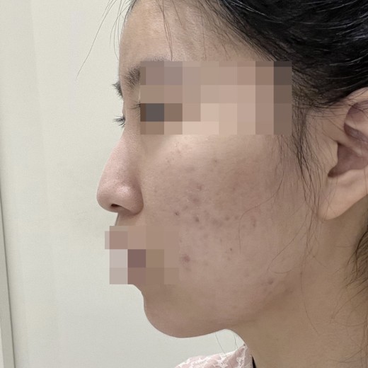 before photo: 코끝(자가연골)