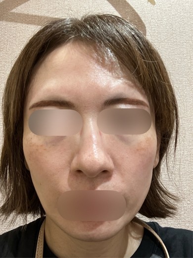 after photo: イオン導入