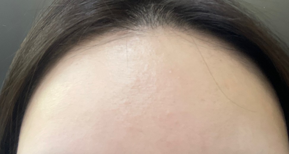 after photo: 여드름압출