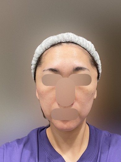before photo: ヴェルベットスキン