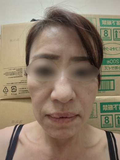 after photo: ハイドラフェイシャル, 診断・検査
