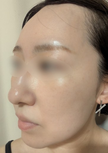after photo: IPL(光/フォト治療), ピーリング