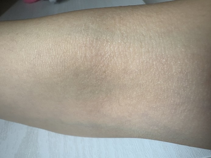 after photo: ビタミン注射・点滴