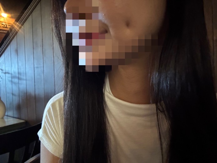 after photo: 보조개성형