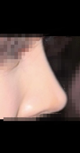 after photo: 비중격만곡증수술, 콧대(자가조직), 코끝(자가연골)