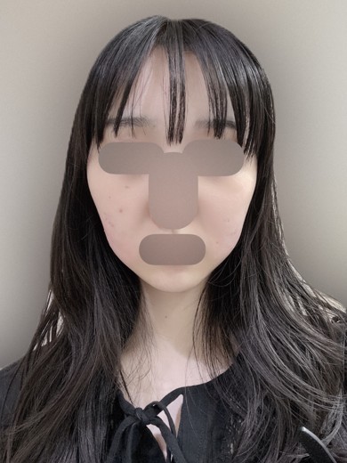 after photo: 脂肪溶解注射(顔)