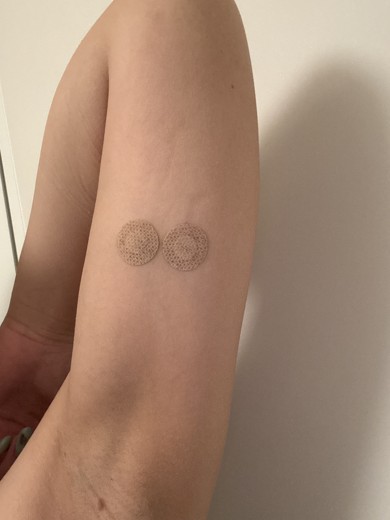 after photo: 脂肪溶解注射(腕), 脂肪溶解注射(太もも)