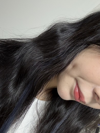 after photo: 보조개성형