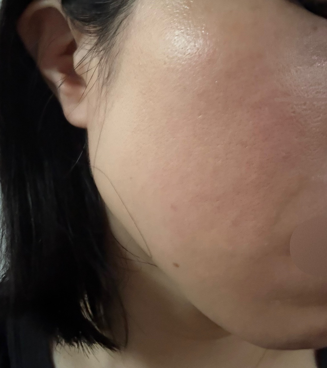 ピーリング　エレクトロポレーション 初診限定】ララピール（全顔）＋エレクトロポレーション