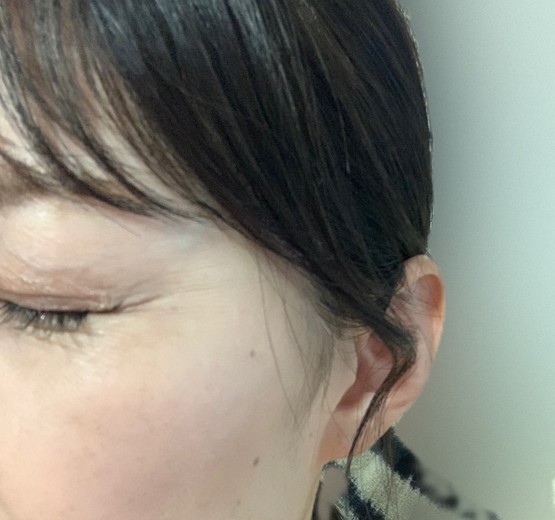after photo: 目尻ボトックス