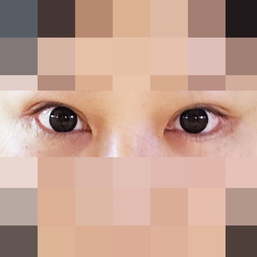 after photo: 밑트임, 뒤트임