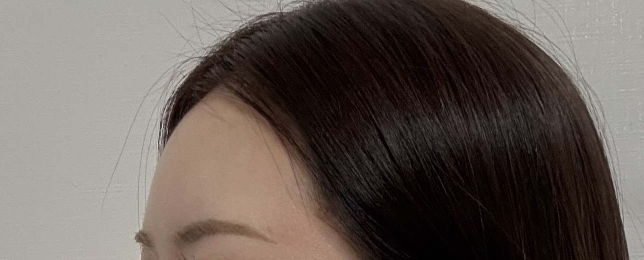 after photo: 이마필러