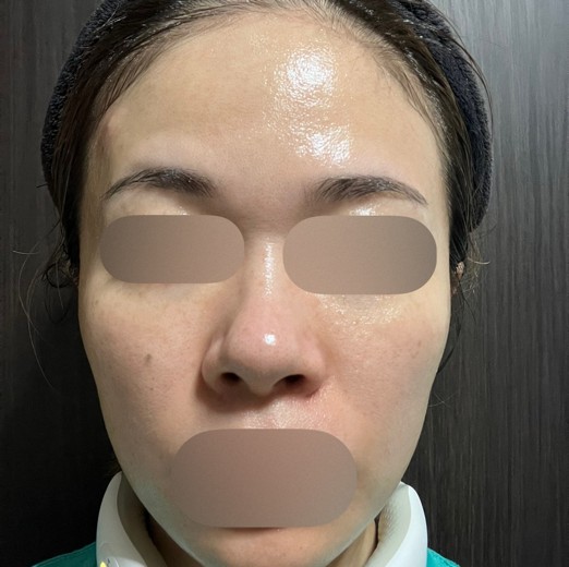 after photo: ピーリング, ルメッカ