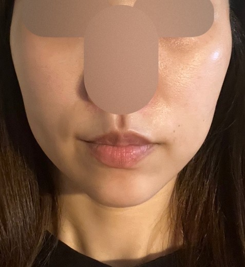 after photo: 糸リフト