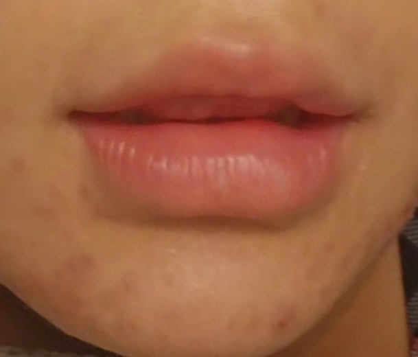 after photo: 입술필러