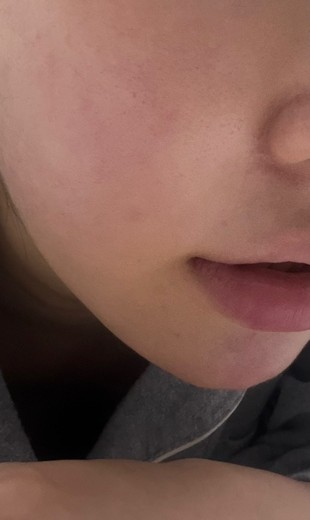 before photo: 인모드리프팅