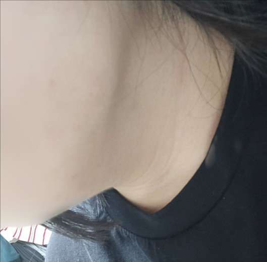 after photo: 사각턱보톡스, 튠라이너