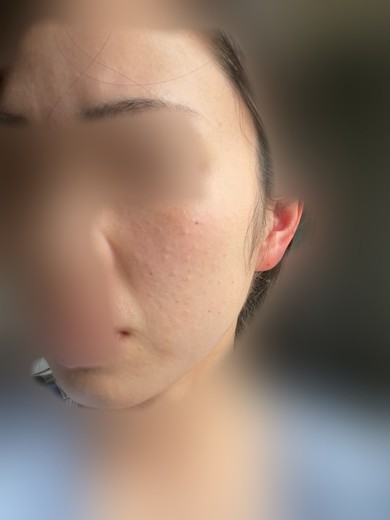 before photo: マッサージピール(コラーゲンピール)
