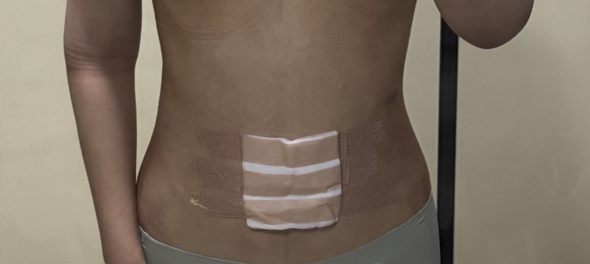 after photo: 복부지방흡입