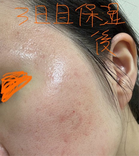 after photo: ダーマペン