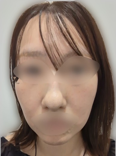 before photo: ルメッカ