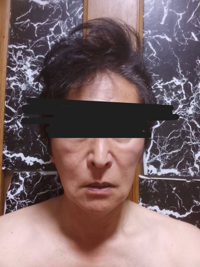 before photo: 脂肪溶解注射(顔)