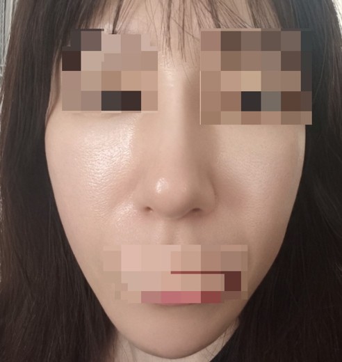 after photo: IPL(光/フォト治療), ピーリング, エレクトロポレーション