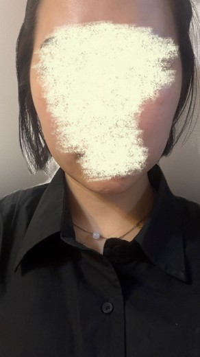 after photo: インモード