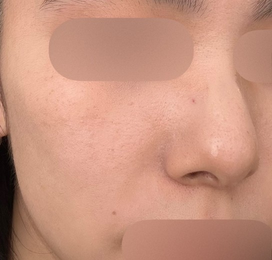 before photo: ルメッカ