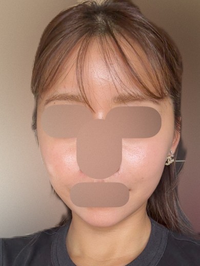 after photo: ボルニューマ