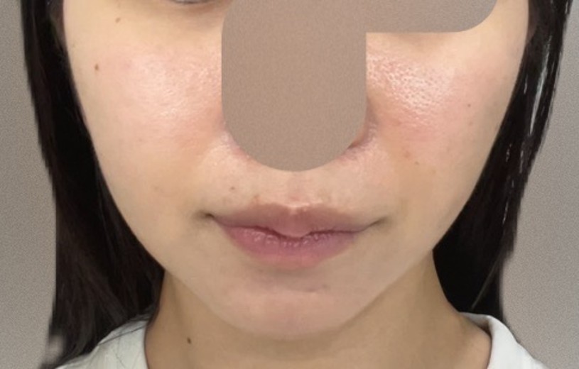 after photo: サーモン注射
