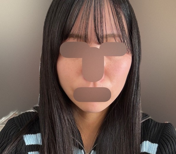 after photo: 糸リフト
