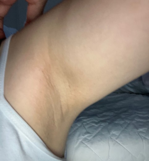 after photo: 겨드랑이제모