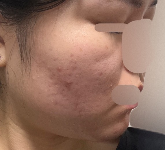 after photo: IPL(光/フォト治療)