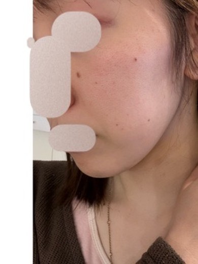 after photo: ルメッカ