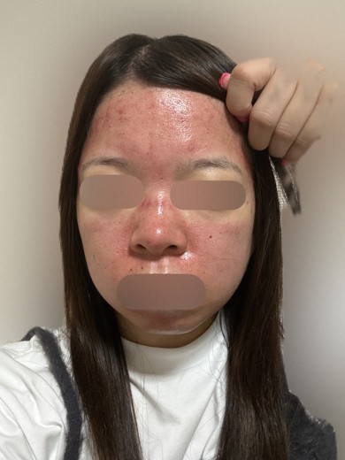 after photo: ダーマペン