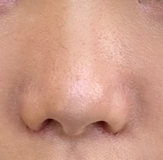 after photo: 콧볼축소