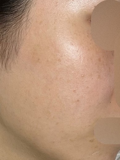 after photo: 白玉注射・点滴