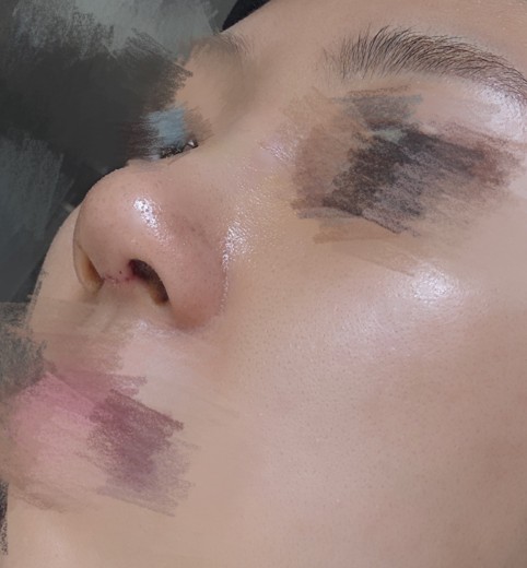 after photo: 콧대(보형물), 코끝(자가연골), 복코교정(수술)