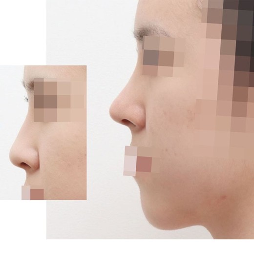after photo: 콧대(자가조직), 콧대(보형물)