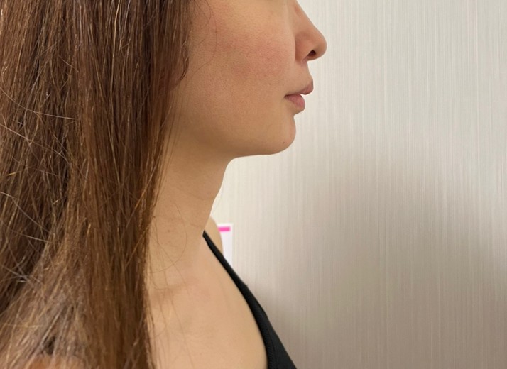 before photo: ハイフ(HIFU)