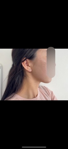 after photo: インモード