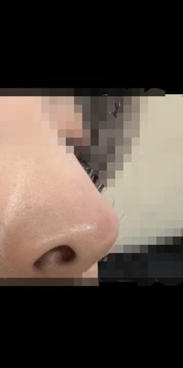 before photo: 비중격만곡증수술, 콧대(자가조직), 코끝(자가연골)