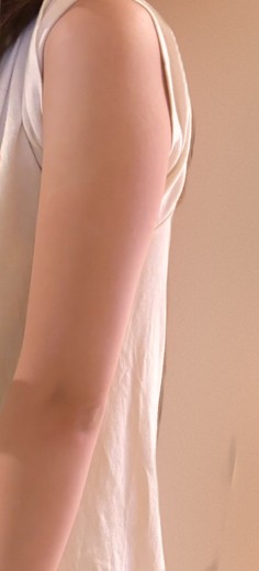 after photo: 脂肪冷却(腕)