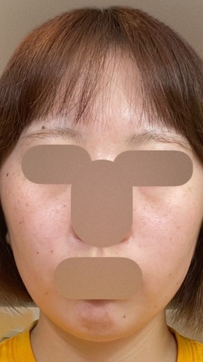 after photo: イオン導入
