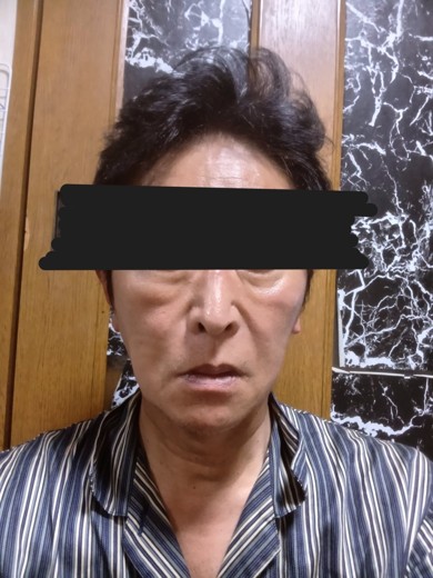 after photo: 脂肪溶解注射(顔)
