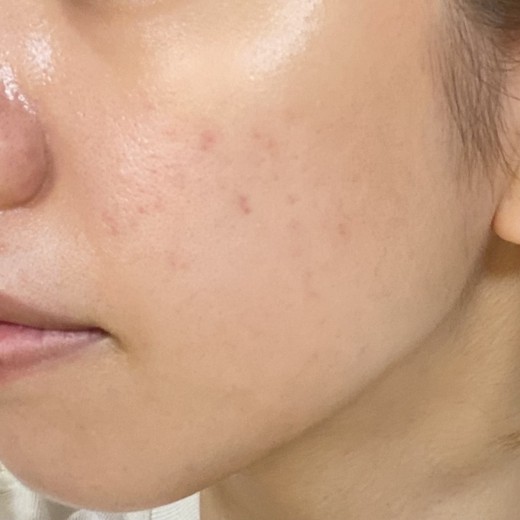 before photo: IPL(光/フォト治療)