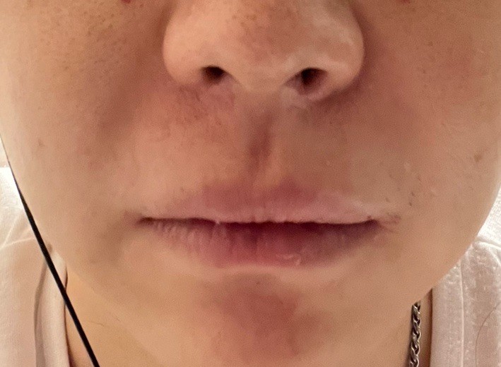 after photo: 脂肪溶解注射(顔)