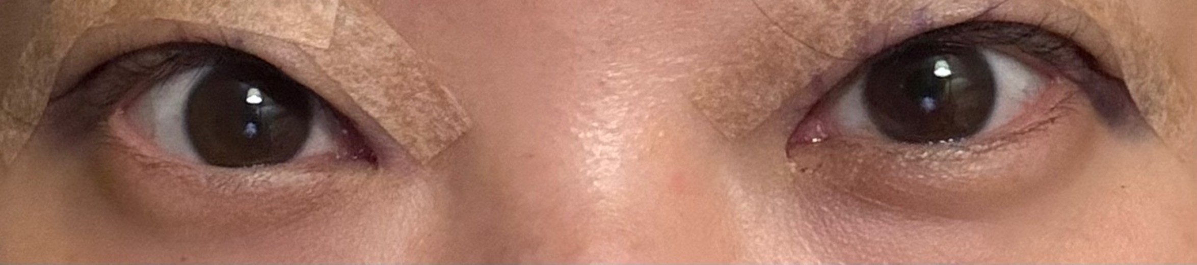 after photo: 눈재수술, 눈매교정